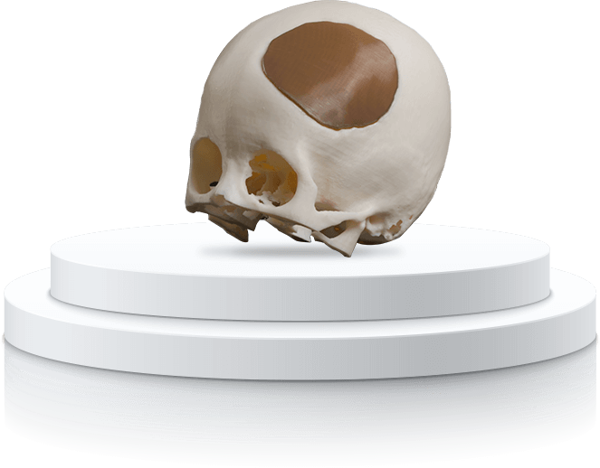 第四军医大学唐都医院 骨瘤患者骨凿切除手术 3D打印PEEK颅骨植入